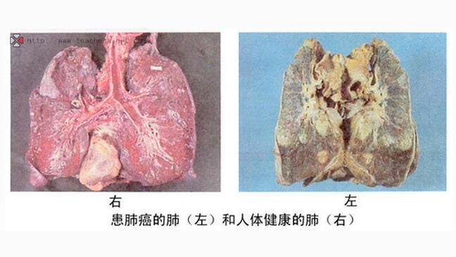 难以置信！74岁肺癌晚期患者奇迹般康复，纯中药竟成‘救命稻草’！