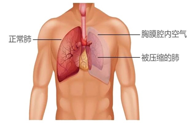 高瘦男生注意！你离气胸可能只有一步之遥，真相令人心惊！
